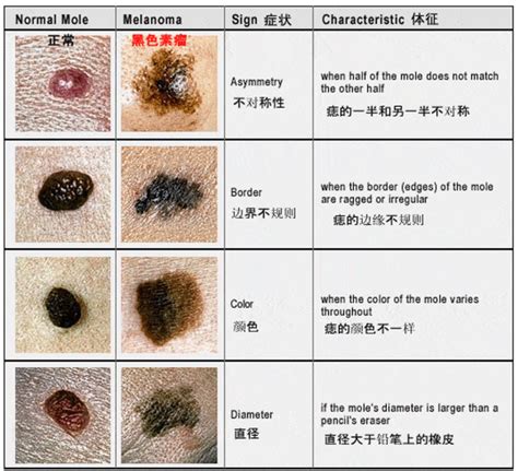 頭上有肉痣|頭上長肉痣有沒危害